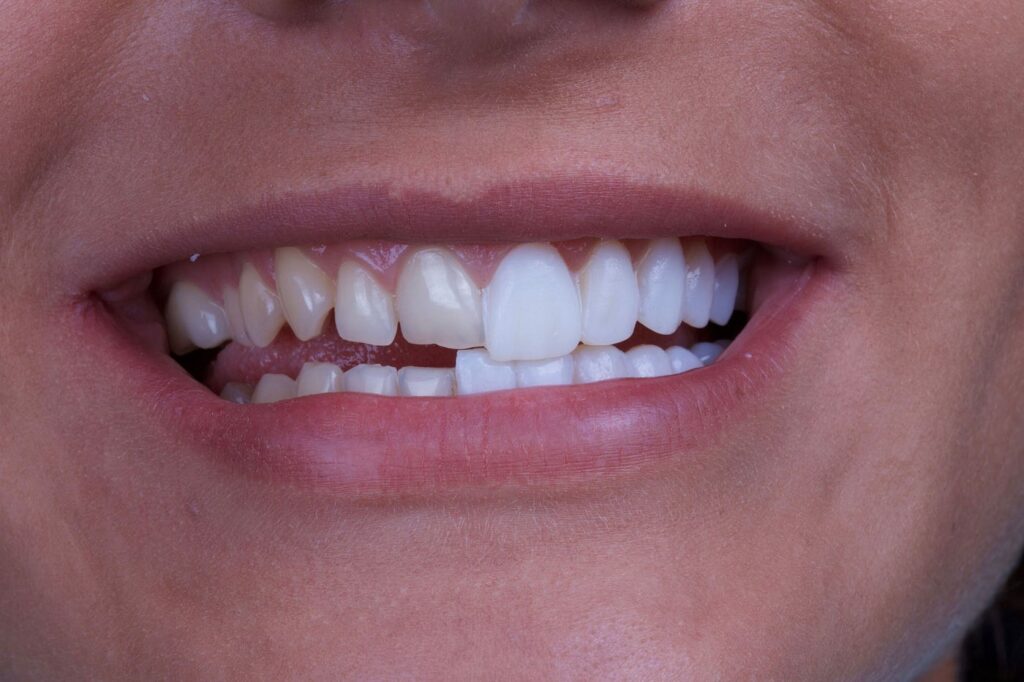 Explore Long-Term Maintenance and Care for Resin Veneers Today - Unlock Your Radiant Smile!