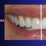 Resin Veneers - Transforming Smiles, Boosting Confidence!