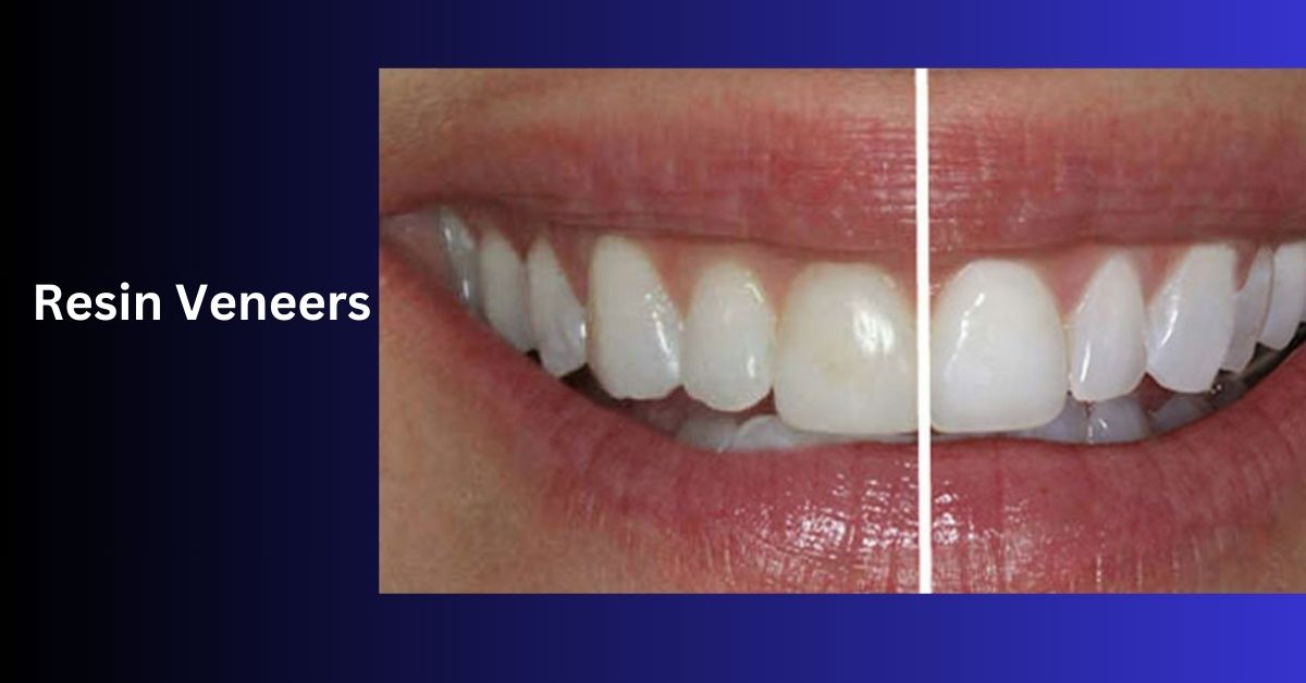 Resin Veneers - Transforming Smiles, Boosting Confidence!