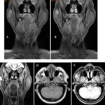 Body Imaging in Evaluating Infectious Diseases