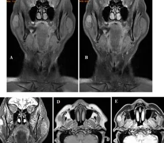 Body Imaging in Evaluating Infectious Diseases