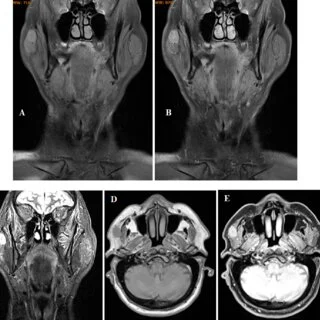 Body Imaging in Evaluating Infectious Diseases