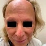 How Scalp Micropigmentation Treats Baldness