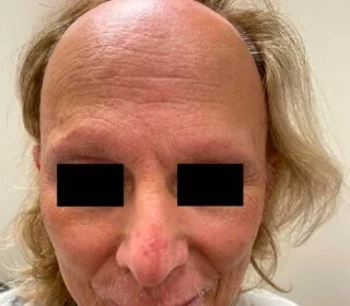 How Scalp Micropigmentation Treats Baldness
