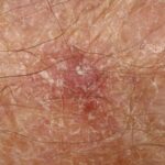 Mohs Surgery for Basal Cell Carcinoma Treatment