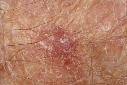 Mohs Surgery for Basal Cell Carcinoma Treatment