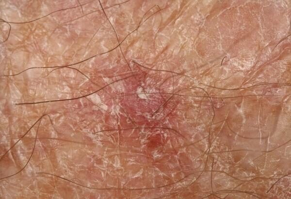 Mohs Surgery for Basal Cell Carcinoma Treatment