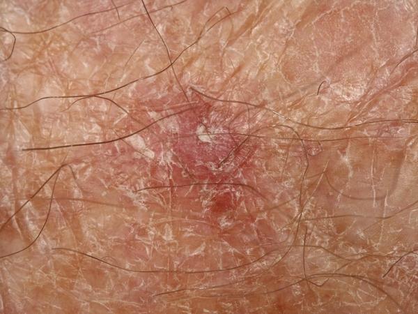 Mohs Surgery for Basal Cell Carcinoma Treatment